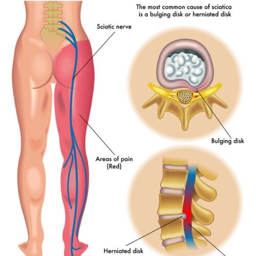 Medical illustration showing the sciatic nerve running from the lower back down the leg, with highlighted red areas indicating common pain regions. The image also includes diagrams of a bulging disk and a herniated disk pressing on the sciatic nerve.