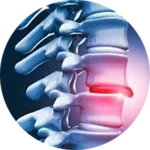 Disc Injury Treatment Near Me in Indian Trail, NC. Chiropractor For Disc Injury Pain Relief.
