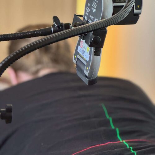 Close-up of a laser therapy device with green lines projected across a patient’s lower back during treatment.